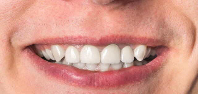 Dental Implants After 01