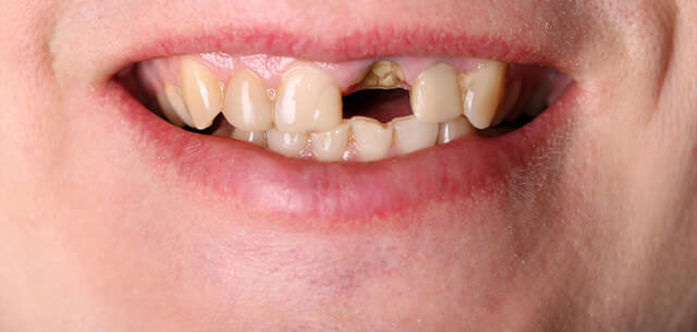 Dental Implants Before 01